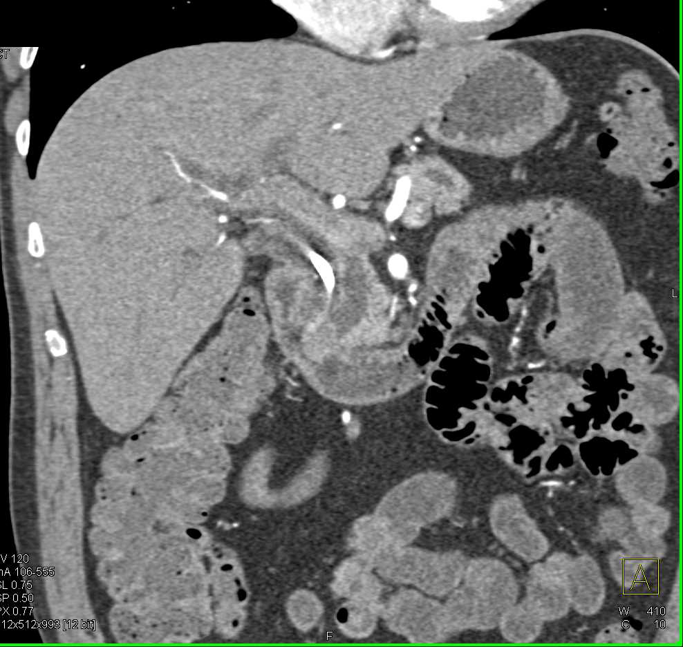 Ampullary Cancer Nicely Seen on Coronal 3D Imaging - CTisus CT Scan