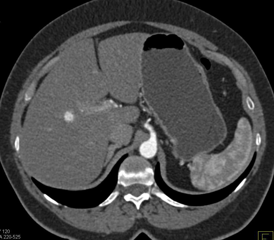 Neuroendocrine Tumor Head of Pancreas - CTisus CT Scan