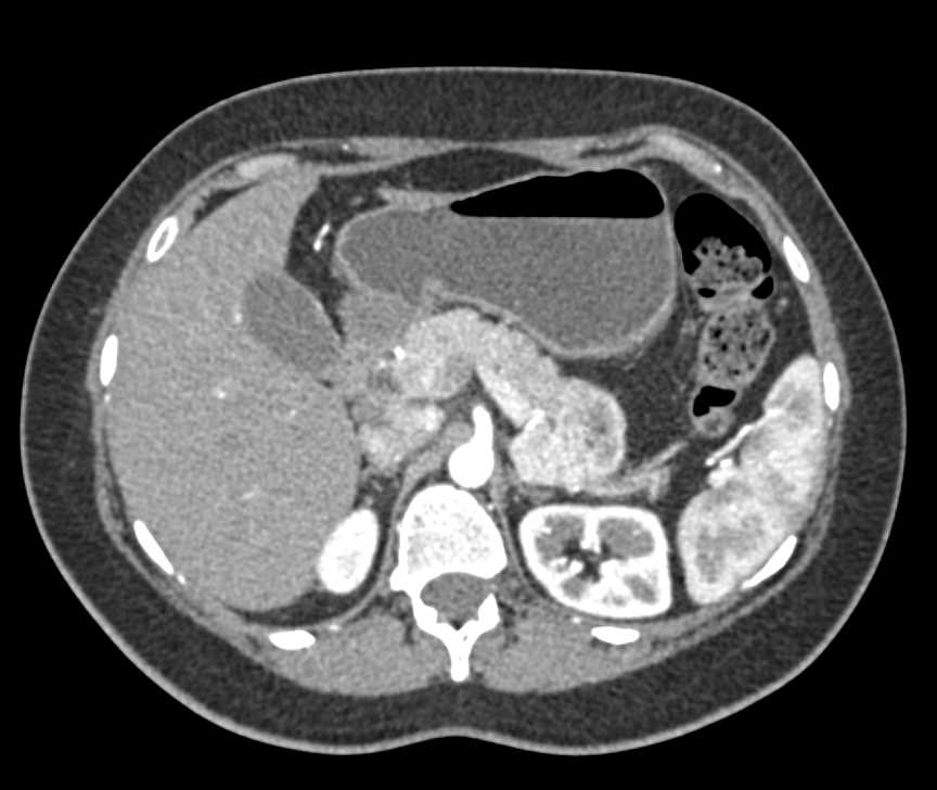 Neuroendocrine Tumor in the Tail of the Pancreas - CTisus CT Scan