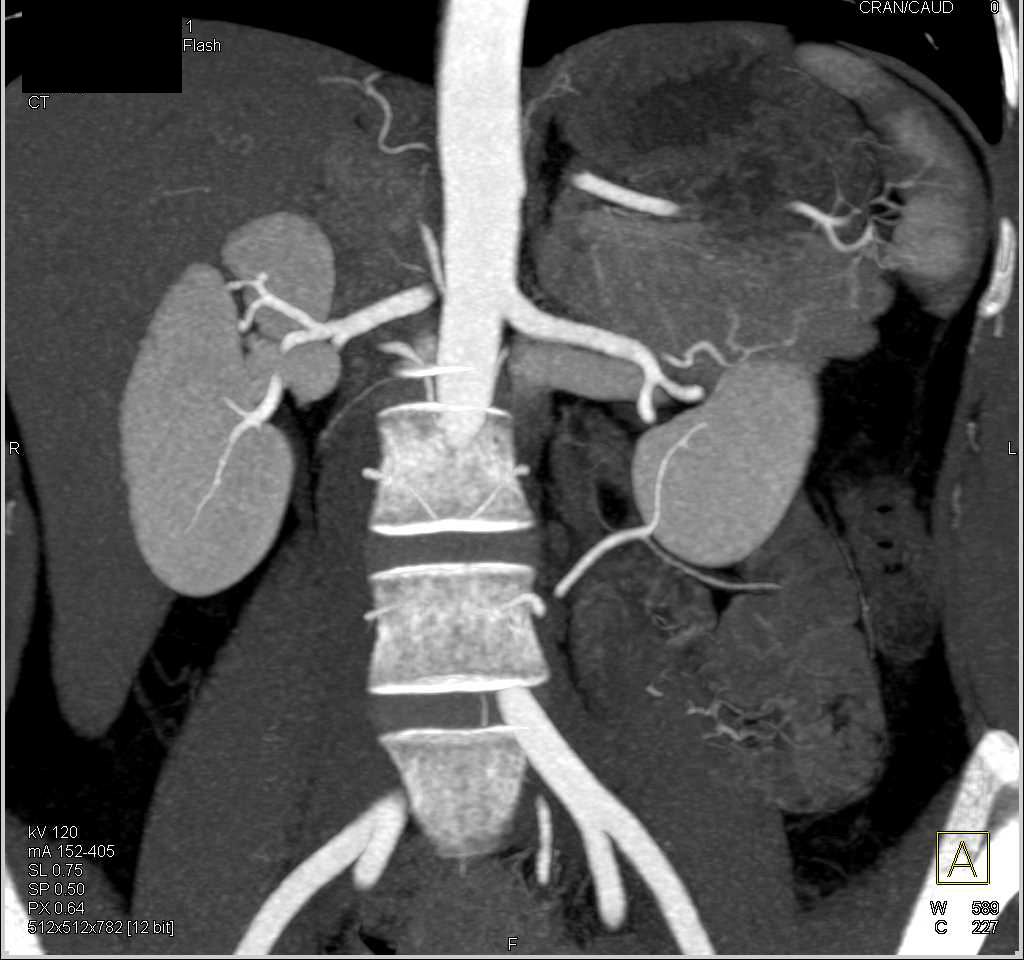 Cystic Pancreatic Tumor - CTisus CT Scan