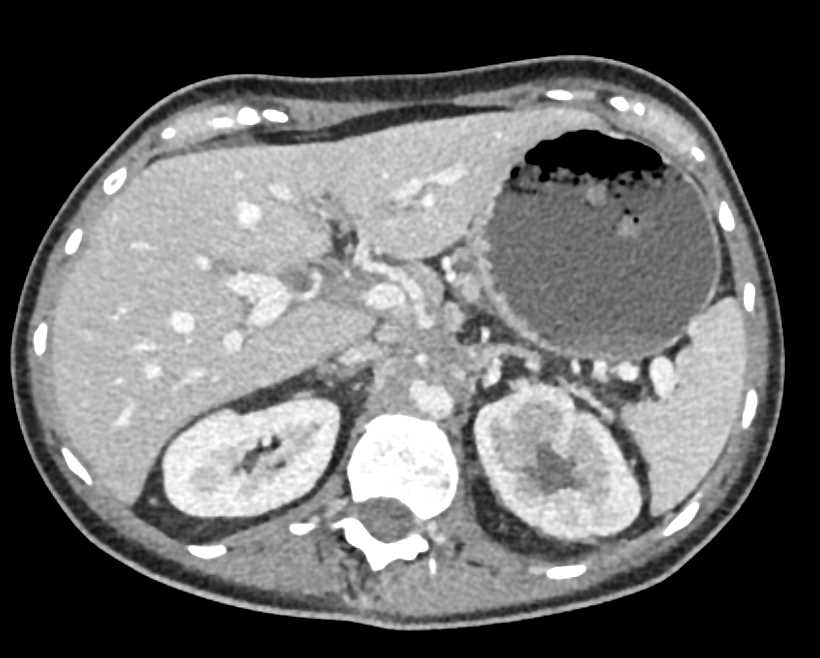 Pancreatic Cancer Encases the Celiac and Superior Mesenteric Artery (SMA) with Infiltration - CTisus CT Scan