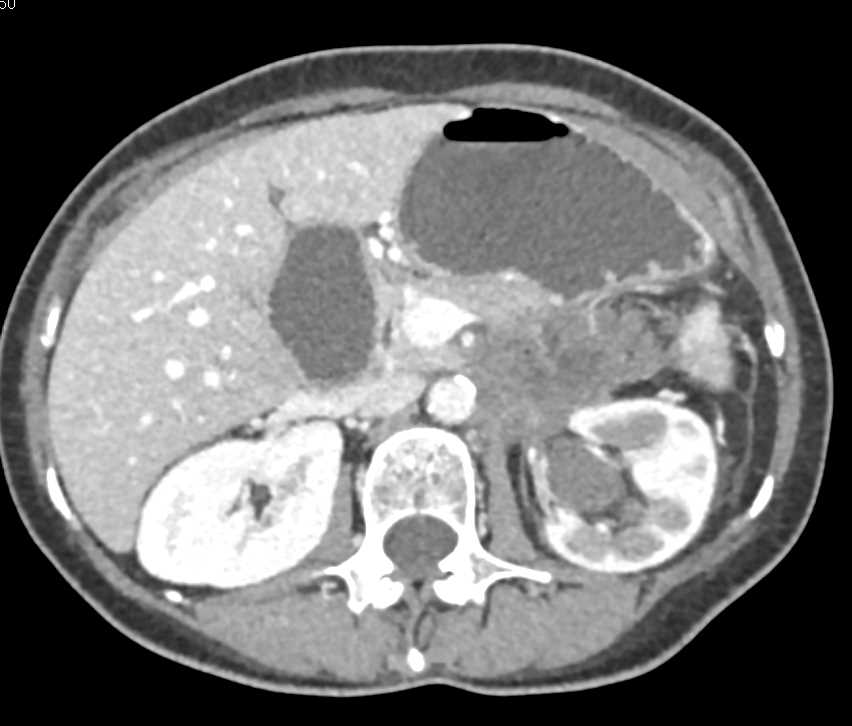 Carcinoma of the Tail of the Pancreas Involves the Left Kidney and Left Renal Artery - CTisus CT Scan