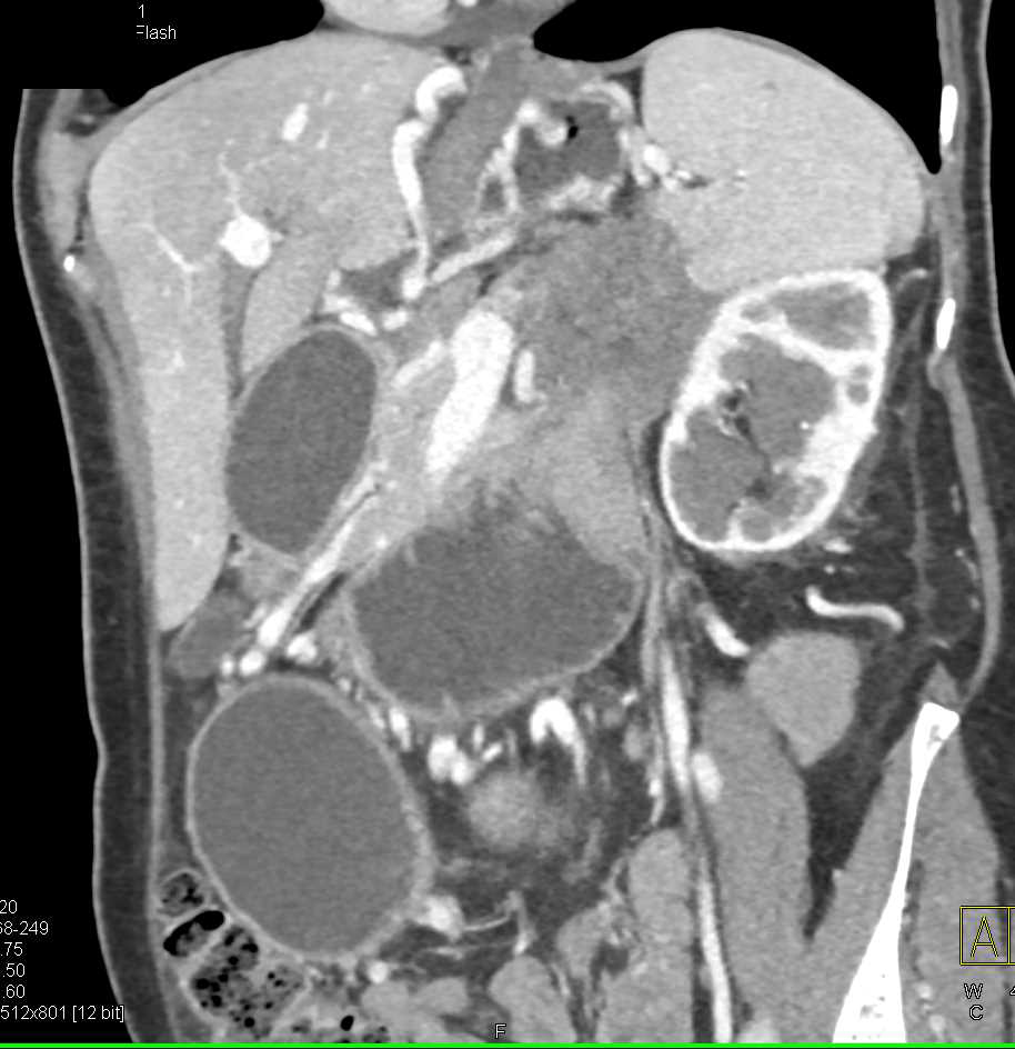 Carcinoma of the Tail of the Pancreas Involves the Left Kidney and Left Renal Artery as Well as Obstruction of the 4th Portion of the Duodenum - CTisus CT Scan