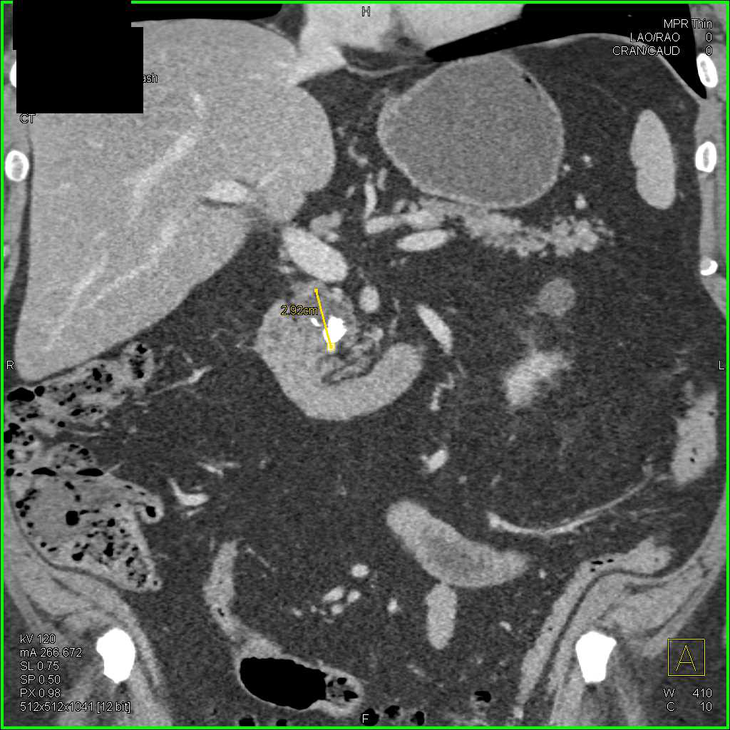 Chronic Pancreatitis - CTisus CT Scan