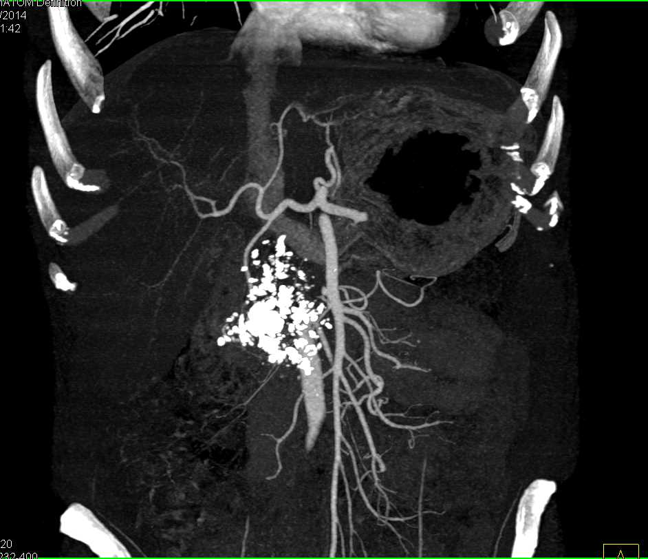 Chronic Pancreatitis with Glandular Calcification and Dilated Pancreatic Duct - CTisus CT Scan