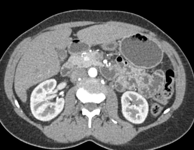 1cm Neuroendocrine Tumor in the Head of the Pancreas - CTisus CT Scan