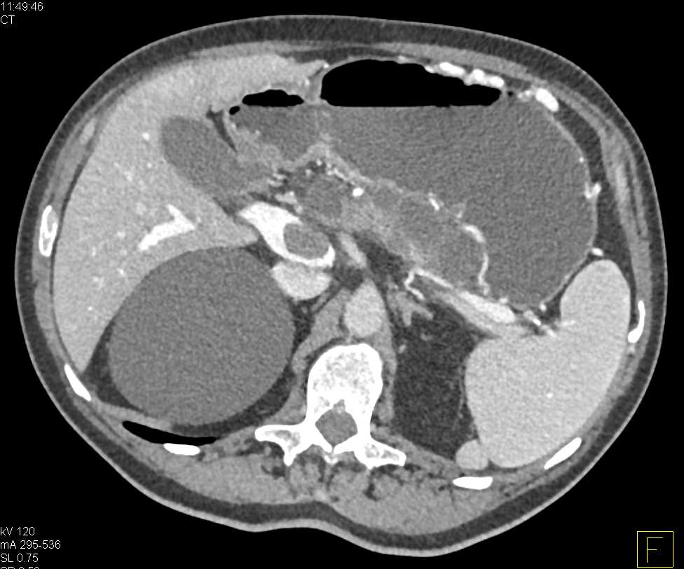 Cystic Neuroendocrine Tumor with Portal Vein Extension Nicely Shown in 3D - CTisus CT Scan