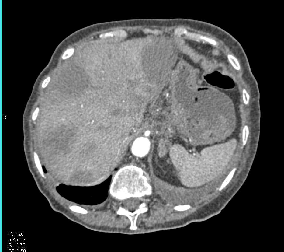 Infiltrating Pancreatic Cancer with Multiple Venous Thrombi - CTisus CT Scan