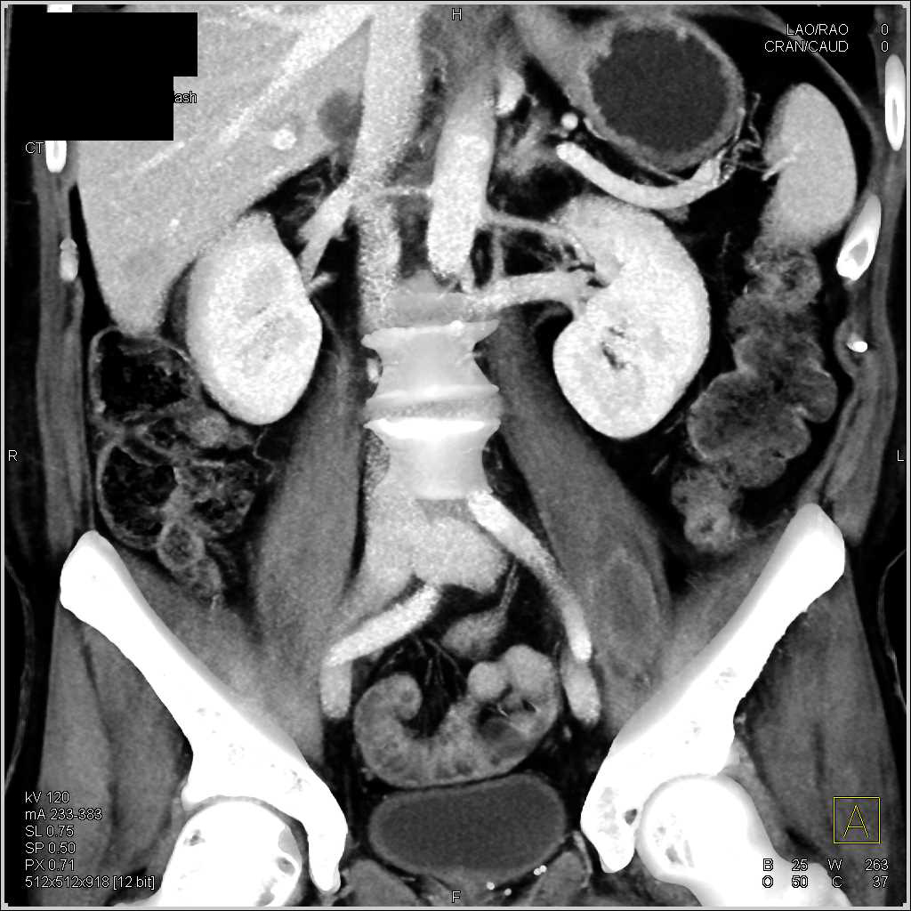 Pancreatic Cancer with Liver Metastases - CTisus CT Scan