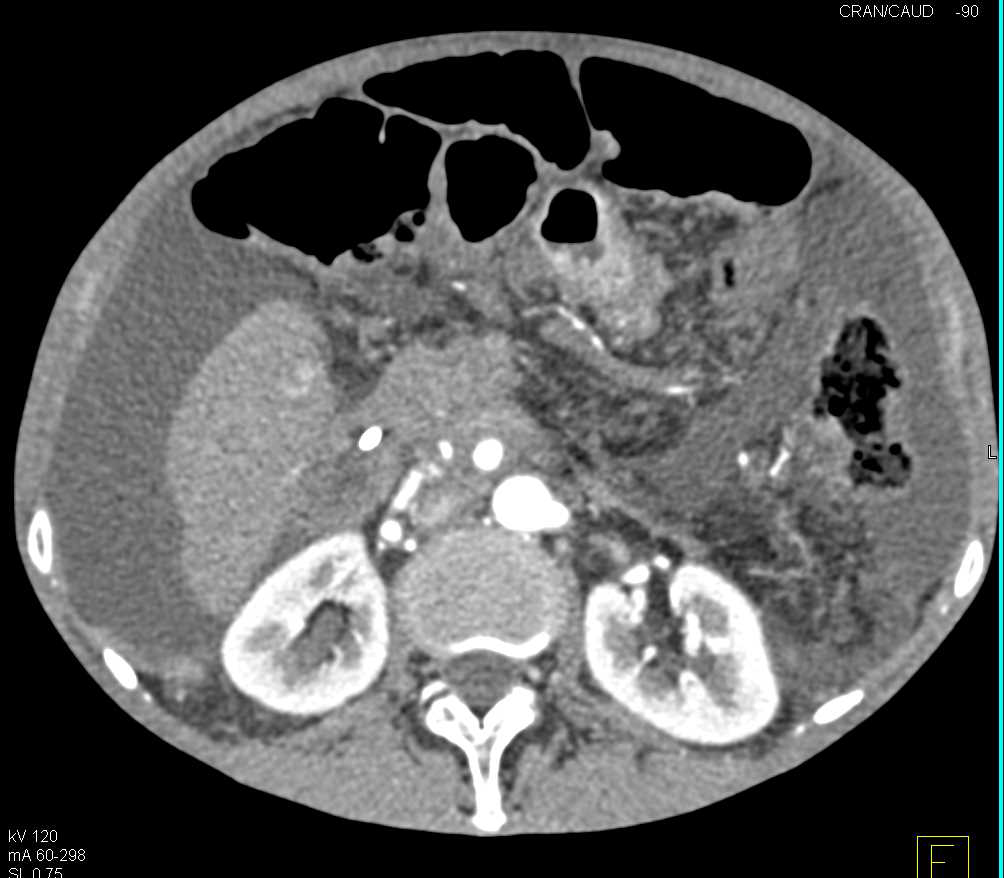 Carcinoma Head of the Pancreas with Carcinomatosis - CTisus CT Scan