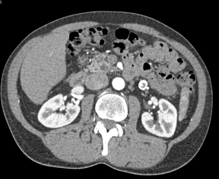 Cystic Pancreatic Tumor due to Intraductal Papillary Mucinous Neoplasm (IPMN) in the Head of the Pancreas - CTisus CT Scan