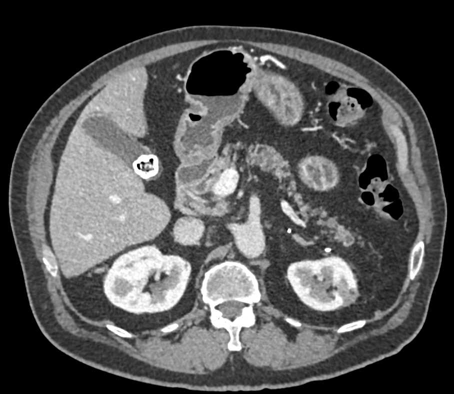 Multiple Intraductal Papillary Mucinous Neoplasms (IPMNs) in the Pancreas - CTisus CT Scan