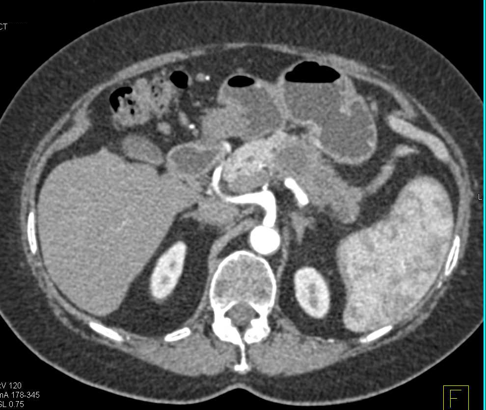 Pancreatic Adenocarcinoma in the Tail of the Pancreas - CTisus CT Scan