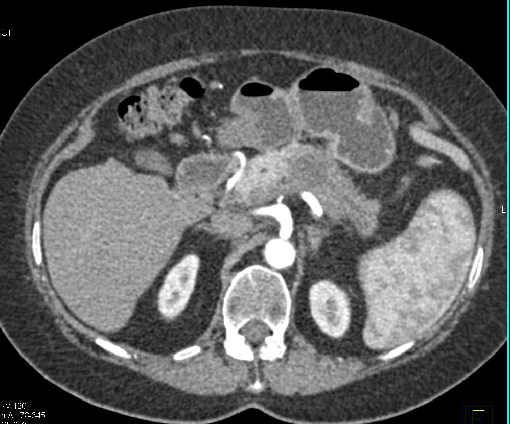 Pancreatic Adenocarcinoma in the Body/Tail of the Pancreas Occludes the Splenic Vein - CTisus CT Scan