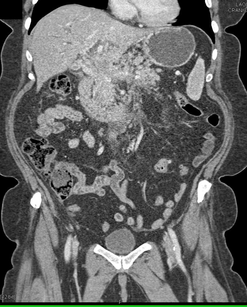 Pancreatic Adenocarcinoma in Head of Pancreas with Arterial and Venous Encasement - CTisus CT Scan