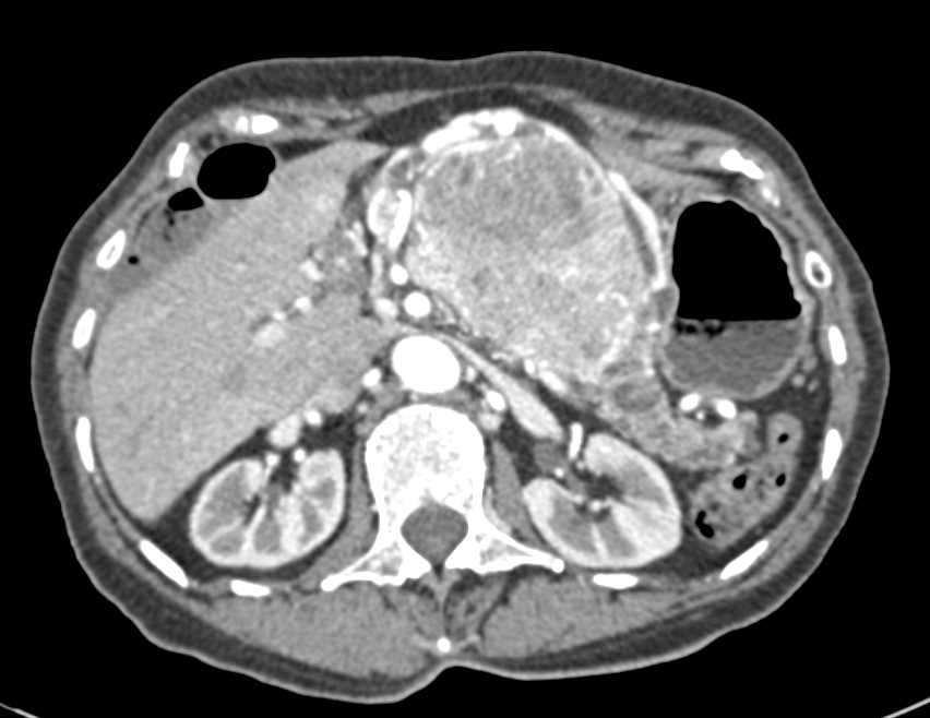 Neuroendocrine Tumor Pancreas Which is Very Vascular - CTisus CT Scan