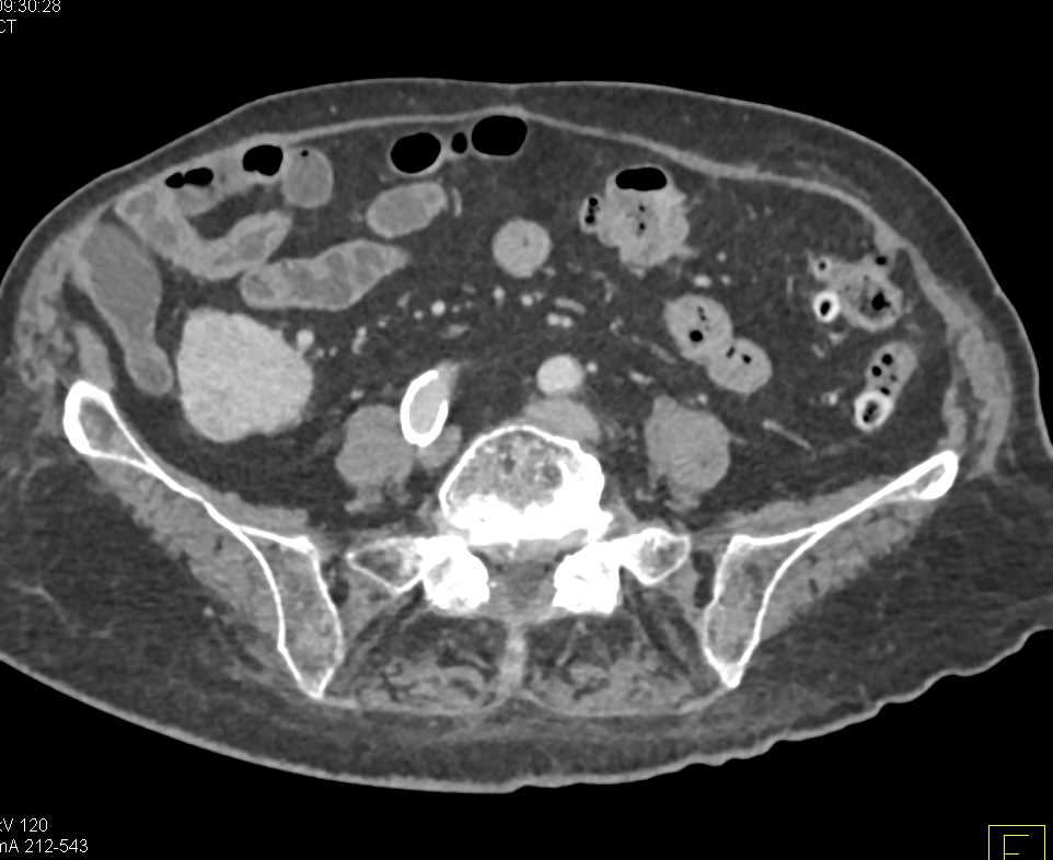 Adenocarcinoma of the Head of the Pancreas with Venous Extension - CTisus CT Scan