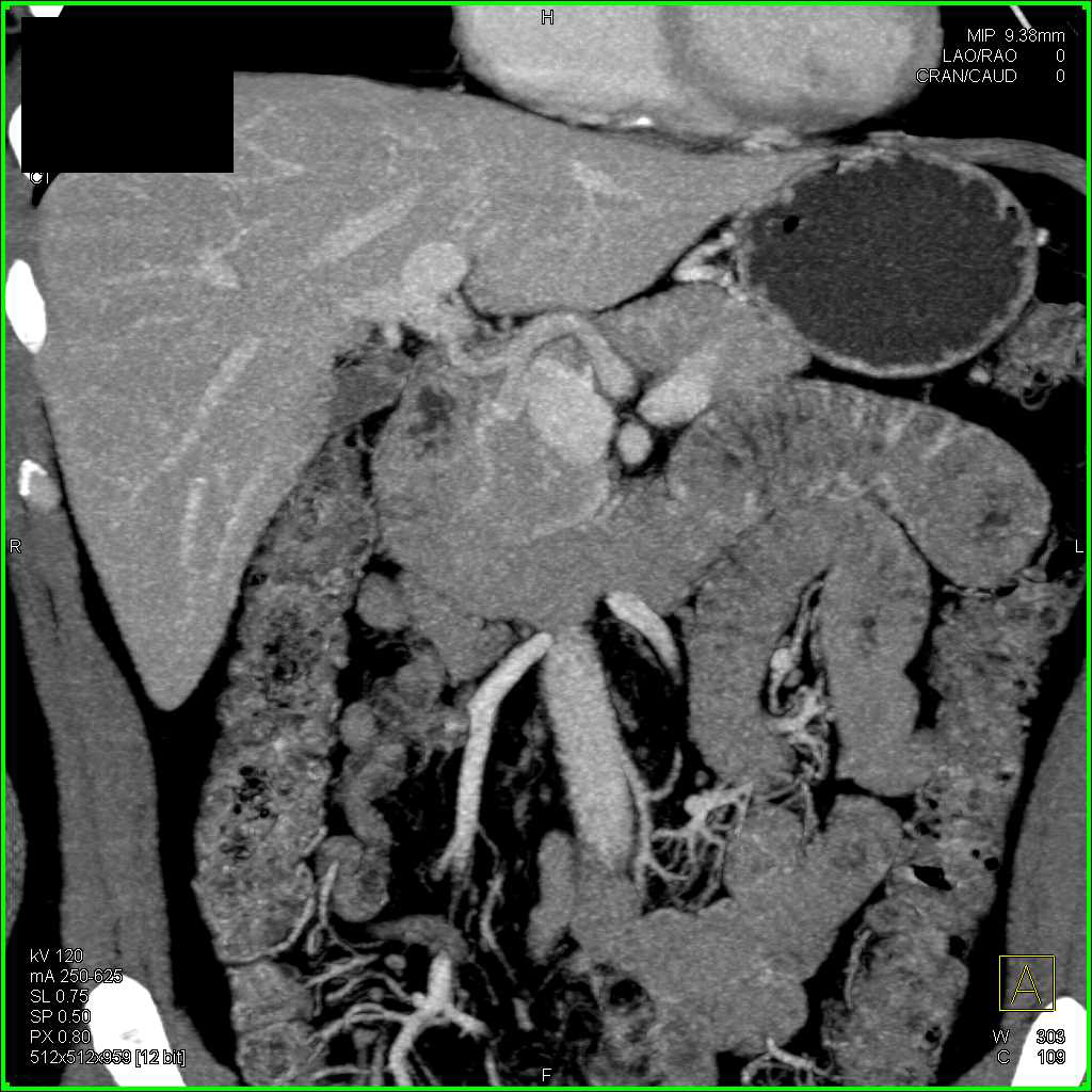 Vascular Serous Cystadenoma - CTisus CT Scan