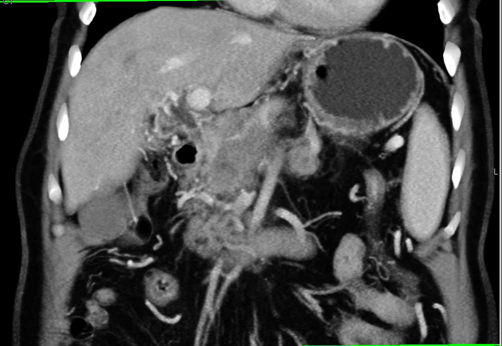 Pancreatic Cancer with Portal Vein Thrombosis - CTisus CT Scan