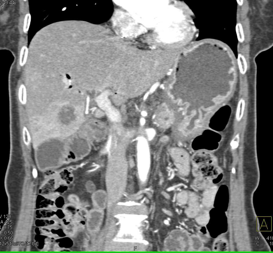 Recurrent Pancreatic Carcinoma with Metastases  to Pancreas and Bowel - CTisus CT Scan