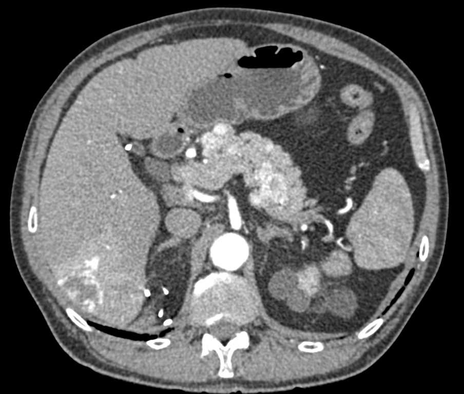 Metastatic Renal Cell Carcinoma to Pancreas and Liver with Vascular Metastases - CTisus CT Scan