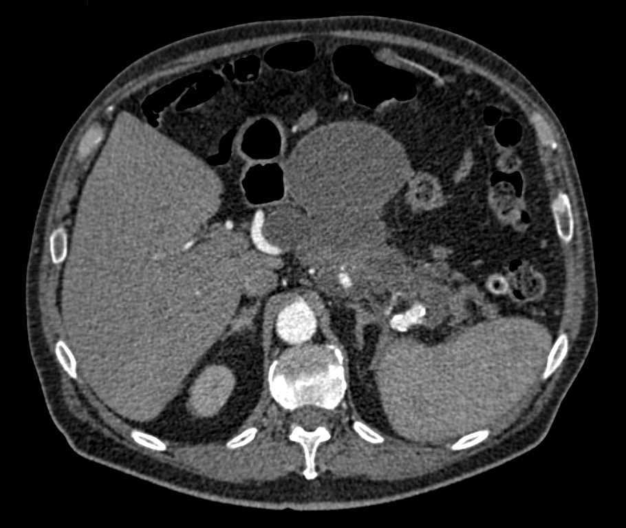 Pancreatic with Large Pseudocyst - CTisus CT Scan