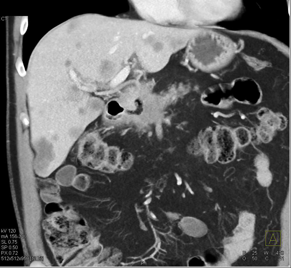 Invasive Pancreatic Adenocarcinoma with Liver Metastases - CTisus CT Scan