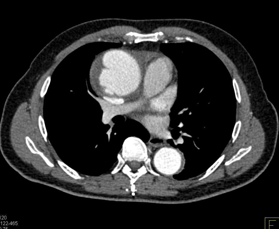 Incidental Neuroendocrine Tumor Tail of Pancreas in Aortic Evaluation Study - CTisus CT Scan