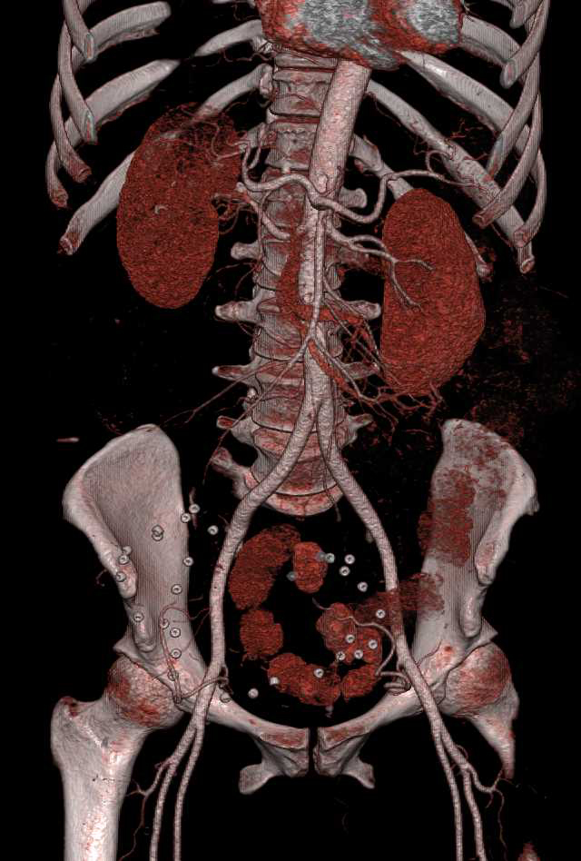 Primary Pancreatic Cancer with Spread of Disease - CTisus CT Scan