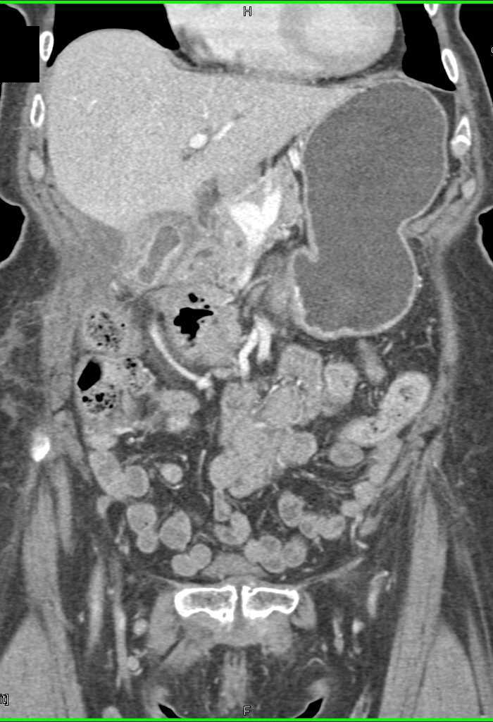 Pancreatic Adenocarcinoma - CTisus CT Scan