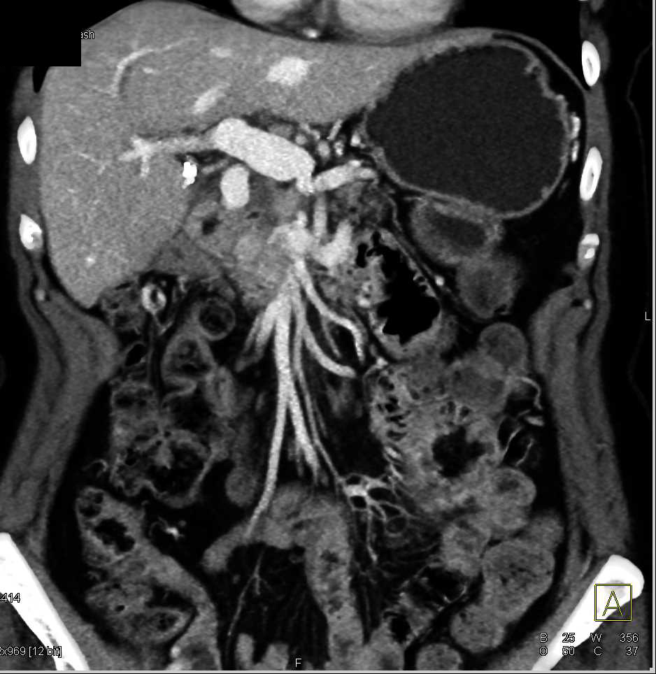 Pancreatic Adenocarcinoma Involves the Superior Mesenteric Vein (SMV) - CTisus CT Scan