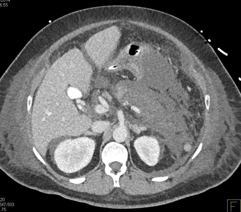 Pancreatic Necrosis with Right Lower Quadrant Abscess - CTisus CT Scan