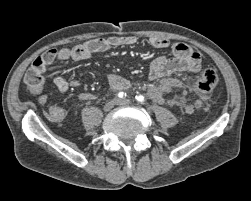 Pancreatic Cancer with Liver Metastases - CTisus CT Scan