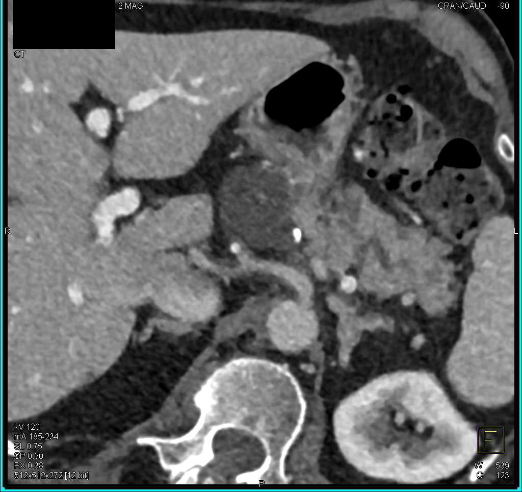 Intraductal Papillary Mucinous Neoplasm (IPMN) Body of Pancreas - CTisus CT Scan