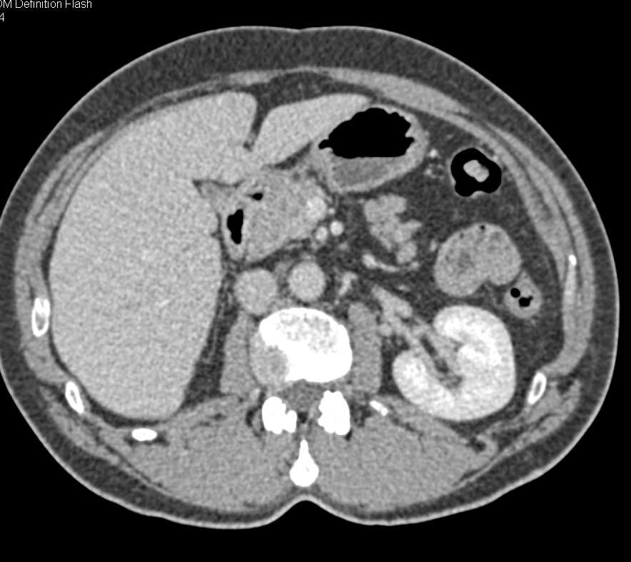 Neuroendocrine Tumor of the Pancreas - CTisus CT Scan