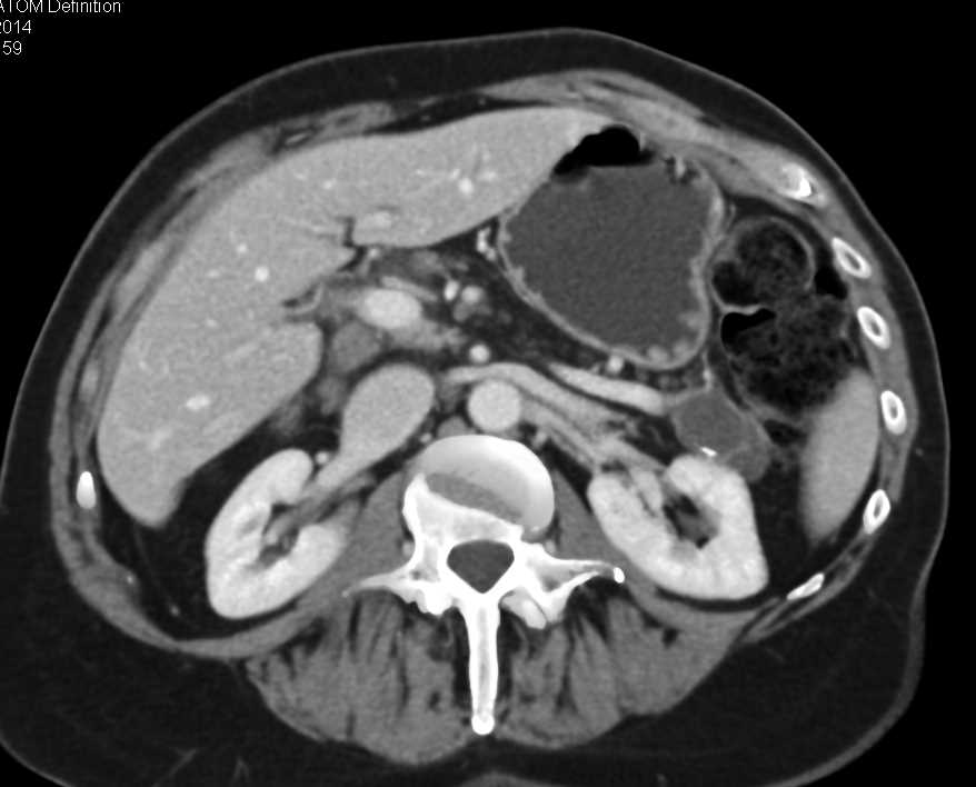 Main Duct Intraductal Papillary Mucinous Neoplasm (IPMN) - CTisus CT Scan