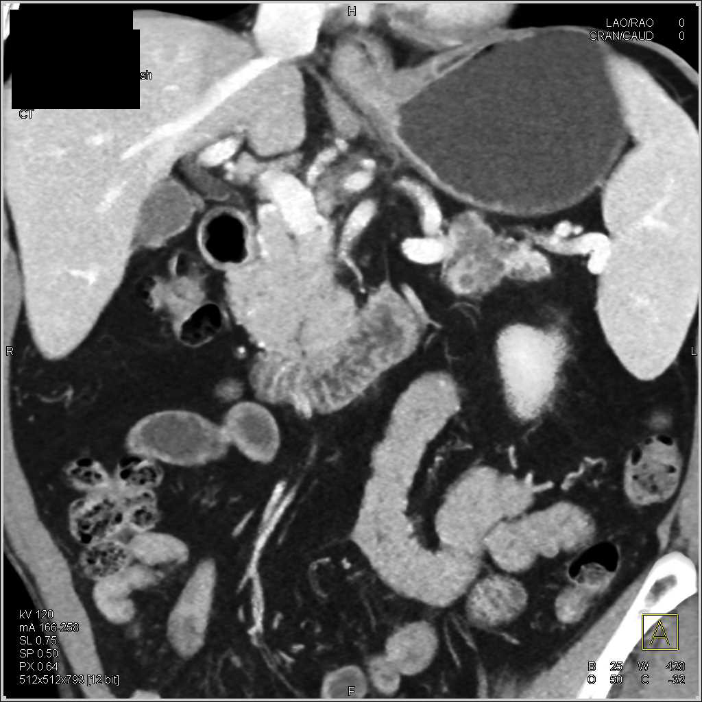 Intraductal Papillary Mucinous Neoplasm (IPMN) with High Grade Dysplasia - CTisus CT Scan