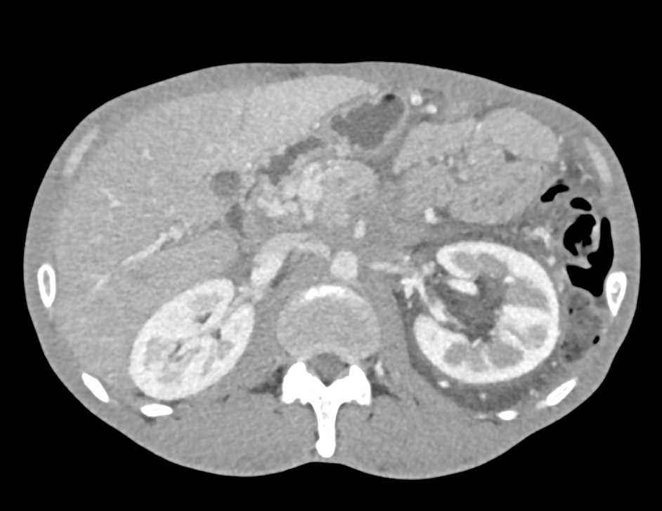 Infiltrating Pancreatic Cancer - CTisus CT Scan