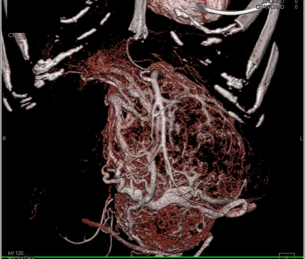 Pancreatic Neuroendocrine Tumor - CTisus CT Scan