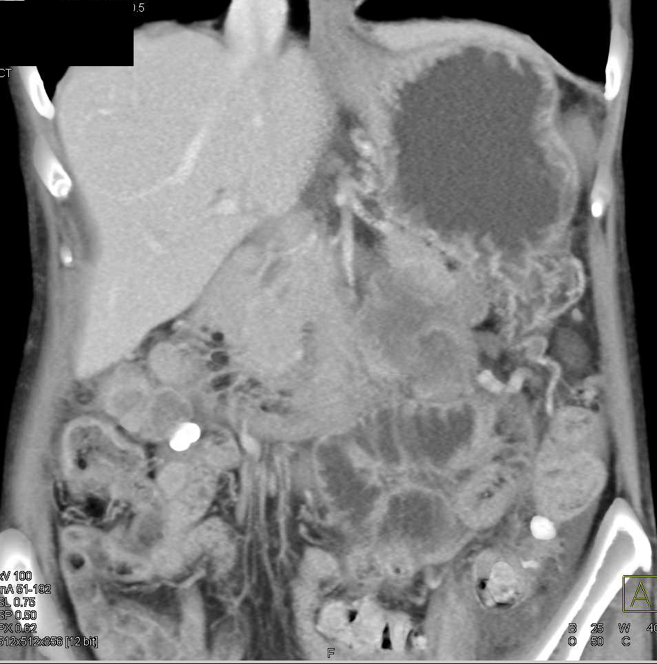 Infiltrating Adenocarcinoma Tail of the Pancreas - CTisus CT Scan