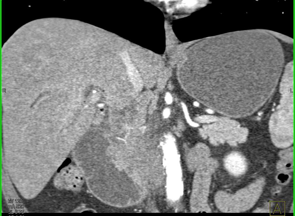 Infiltrating Adenocarcinoma of the Head of the Pancreas - CTisus CT Scan