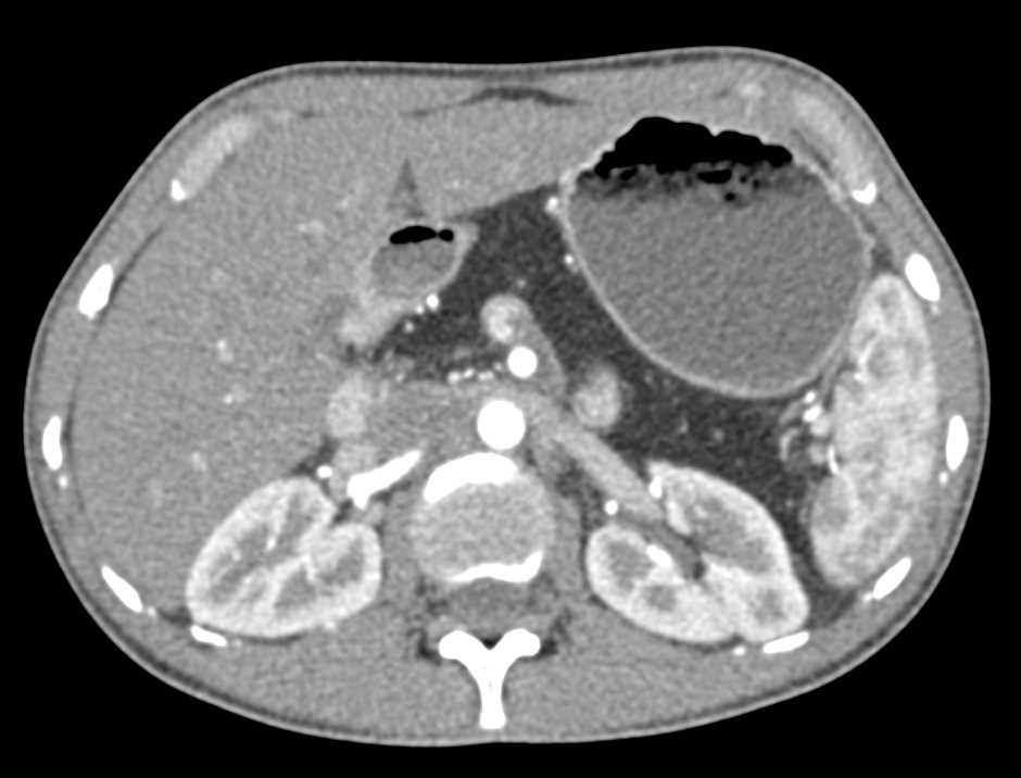 Cystic Fibrosis with Fatty Replacement of the Pancreas - CTisus CT Scan