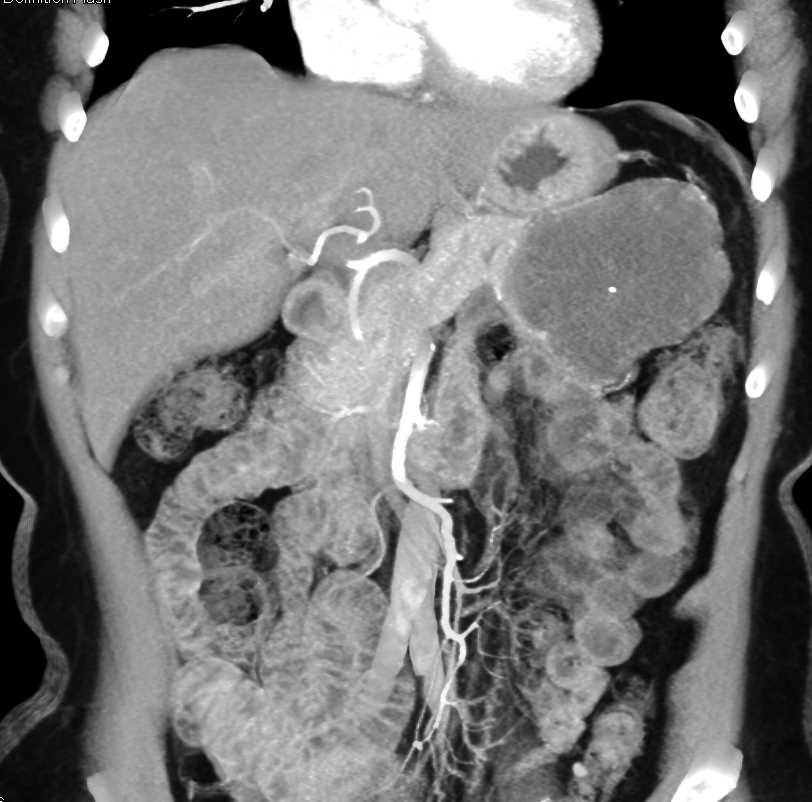 Serous Cystadenoma and Dilated Small Bowel - CTisus CT Scan