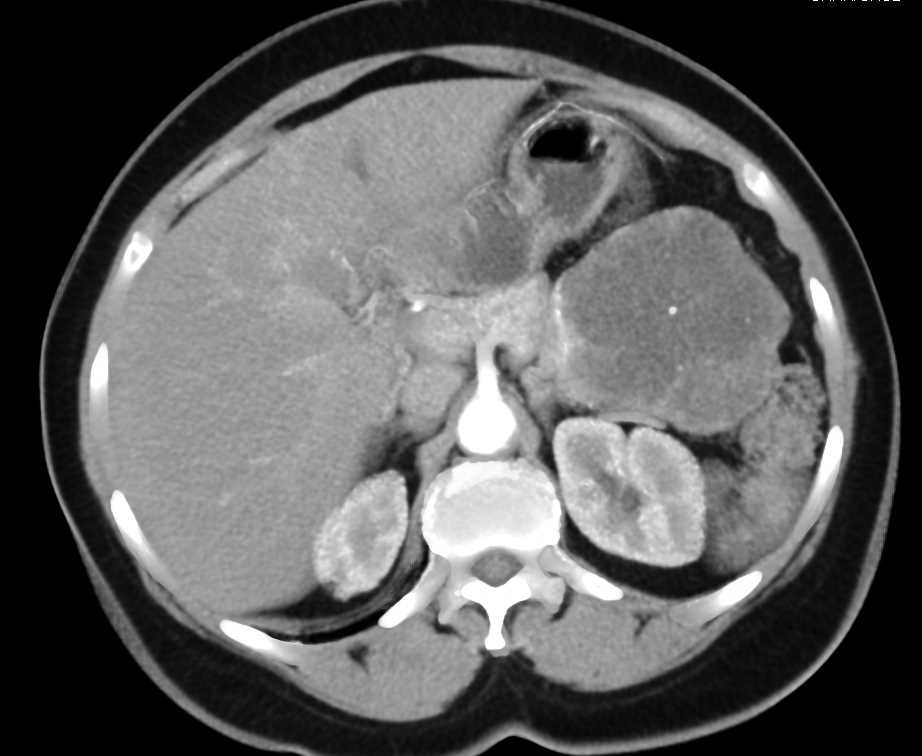 Serous Cystadenoma of the Tail of the Pancreas - CTisus CT Scan