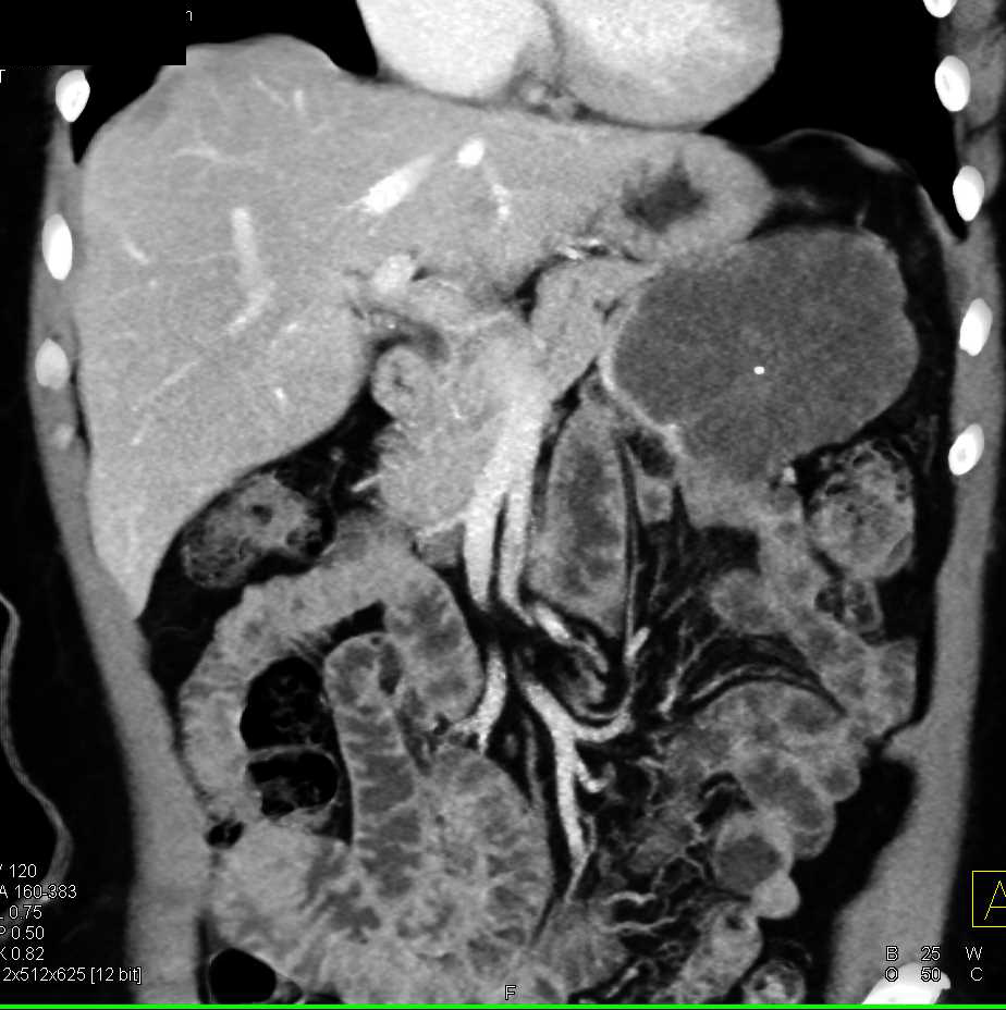 Serous Cystadenoma of the Tail of the Pancreas - CTisus CT Scan