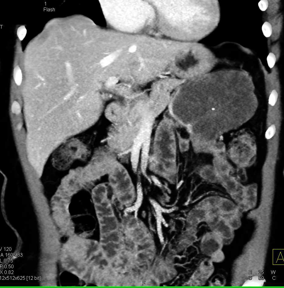 Serous Cystadenoma of the Tail of the Pancreas - CTisus CT Scan