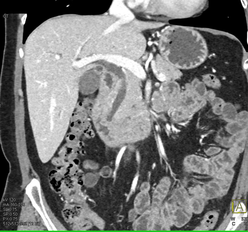 1 cm Ampullary Carcinoma with Dilated Common Bile Duct (CBD) - CTisus CT Scan