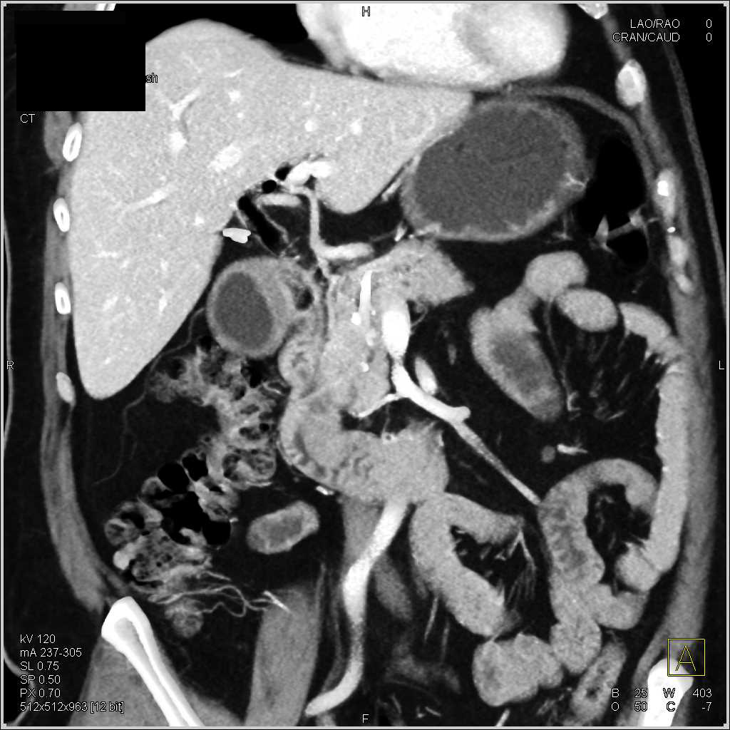 Ampullary Carcinoma Obstructs Common Bile Duct (CBD) and Invades Duodenum - CTisus CT Scan