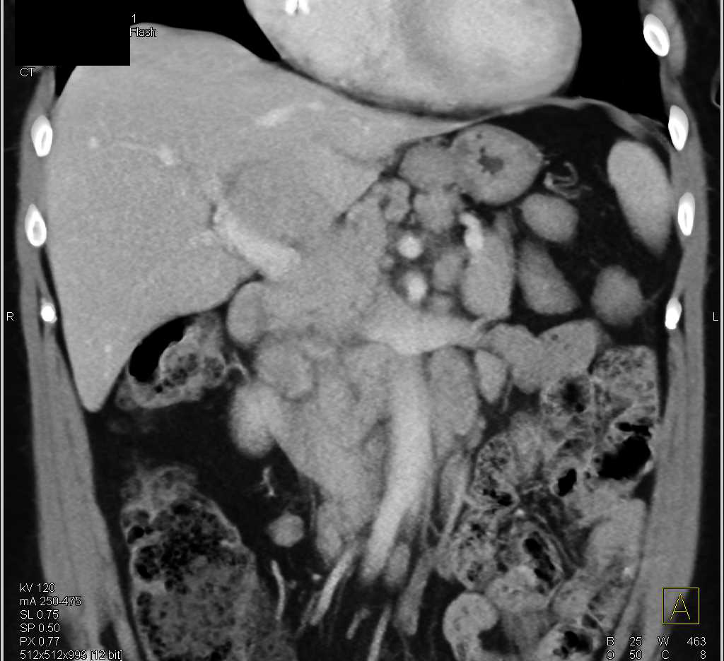 Lymphoma Simulates a Carcinoma of the Pancreas - CTisus CT Scan