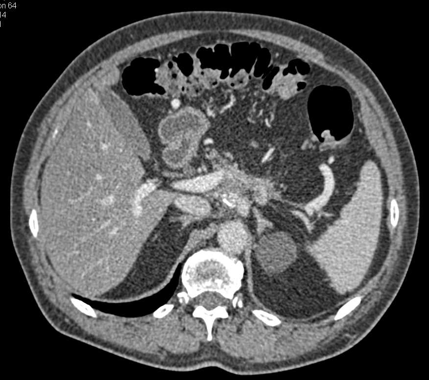 Subtle Pancreatic Cancer - CTisus CT Scan